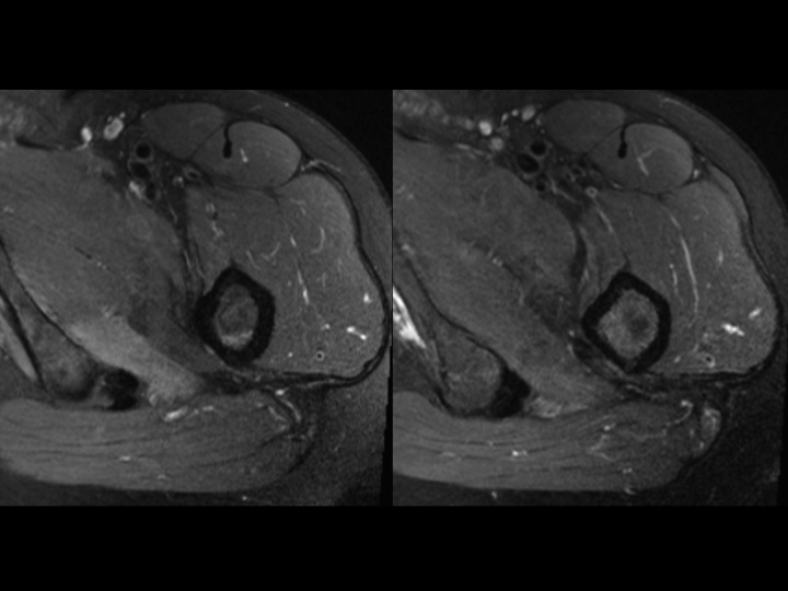 Figure 4 for case acetabular-femoral impingement